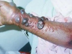 Ebola elleni kisérleti gyógyszereket és oltóanyagokat tesztelnek