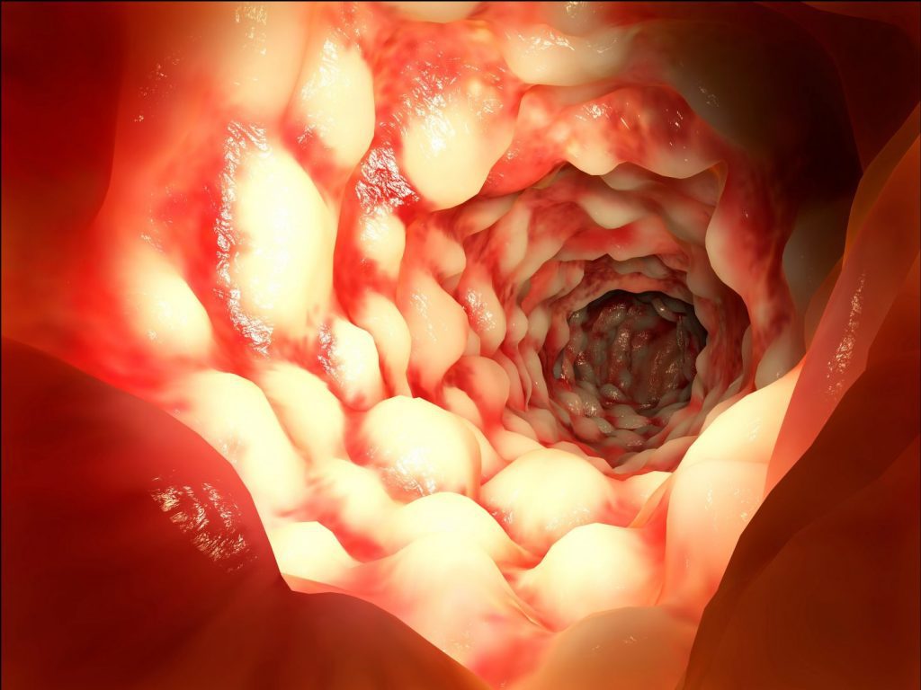 Mi is az a Crohn-betegség? II.