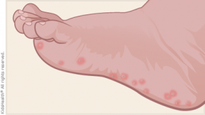 Kéz-láb-száj vírus – az új gyerekbetegség