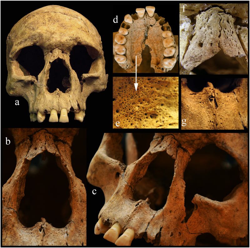2. kép A leprára utaló tipikus csonttani tünetek (a-c) – porozitás (d-e), gyulladás- és csontfelszívódás nyomai (f-g) – az arckoponyán (257. obj. S20). (Forrás: Köhler et al. 2017 - Fig 4)