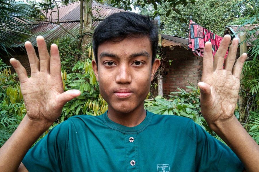 Egy bangladesi családban az anyán kívül mindenki ujjlenyomat nélkül született. Ez sok nehézséget okoz nekik, hiszen még SIM-kártyát sem vásárolhatnak. Forrás: bbc.com
